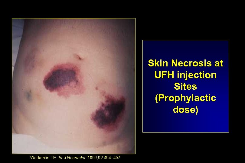 Skin Necrosis at UFH injection Sites (Prophylactic dose) Warkentin TE. Br J Haematol. 1996;