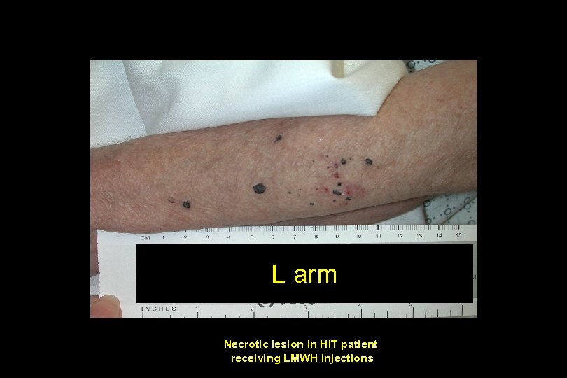 L arm Necrotic lesion in HIT patient receiving LMWH injections 