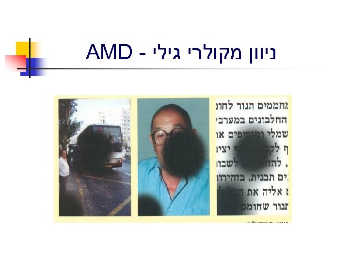  ניוון מקולרי גילי - AMD 
