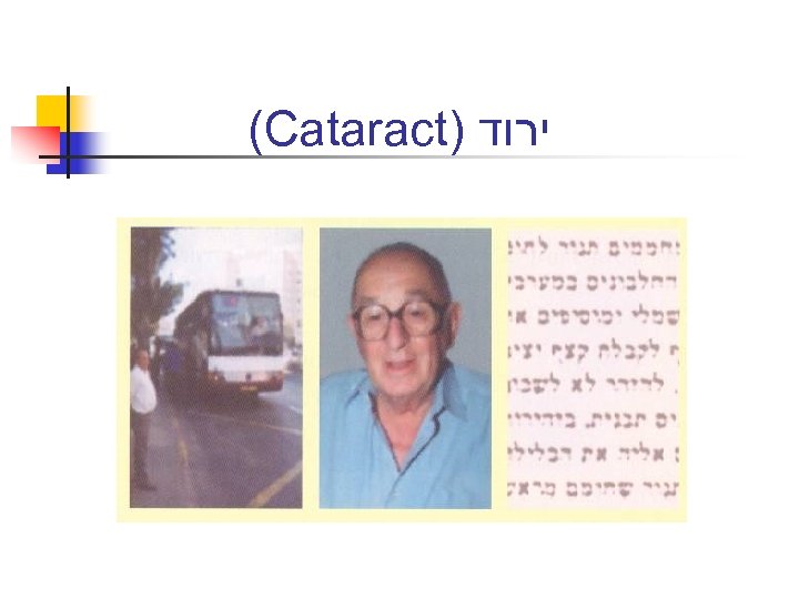 (Cataract) ירוד 