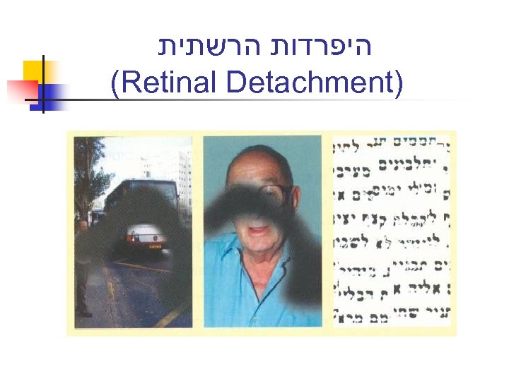  היפרדות הרשתית (Retinal Detachment) 