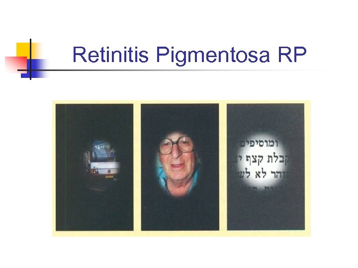 Retinitis Pigmentosa RP 