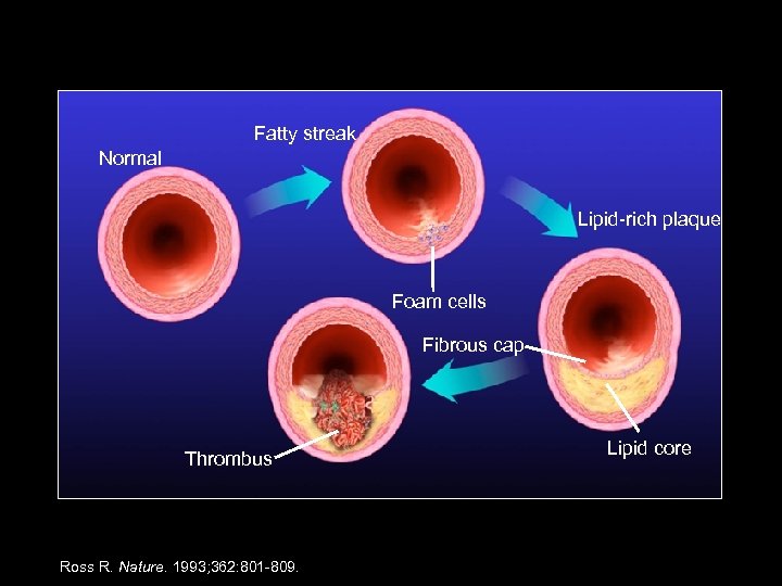 Development of Atherosclerotic Plaques Fatty streak Normal Lipid-rich plaque Foam cells Fibrous cap Thrombus