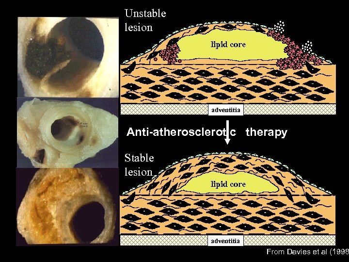 Unstable lesion lipid core adventitia Anti-atherosclerotic therapy Stable lesion lipid core adventitia From Davies