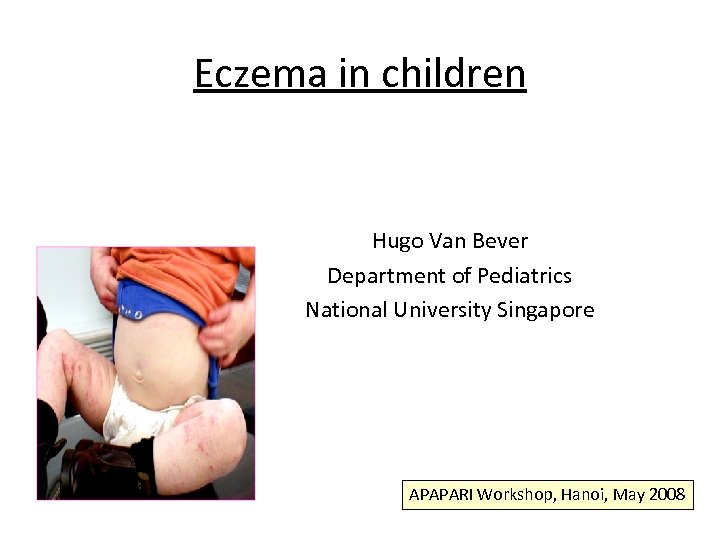 Eczema in children Hugo Van Bever Department of Pediatrics National University Singapore APAPARI Workshop,