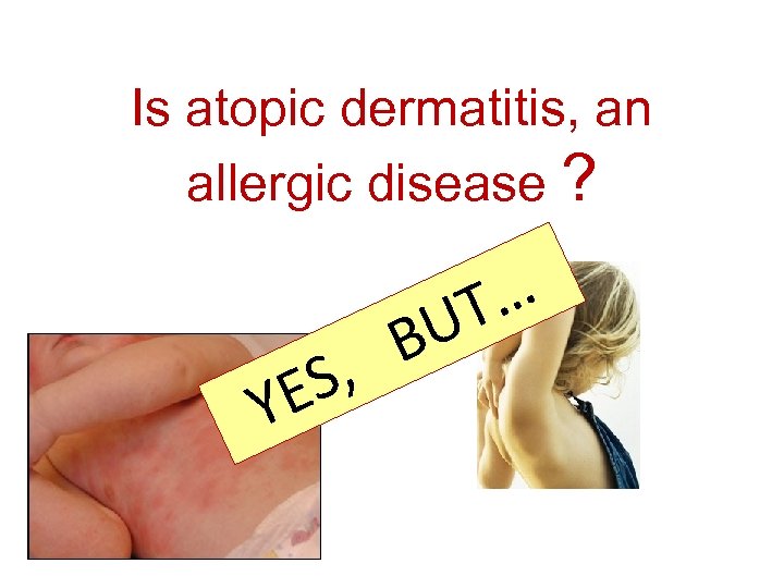 Is atopic dermatitis, an allergic disease ? B S, YE … T U 