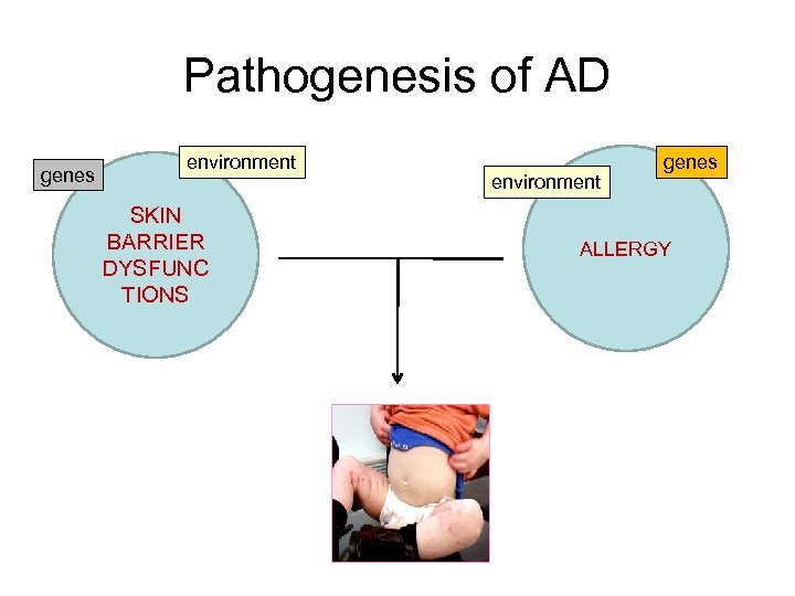 Pathogenesis of AD genes environment SKIN BARRIER DYSFUNC TIONS environment genes ALLERGY 