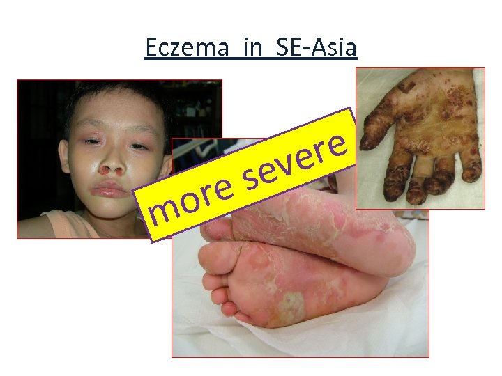 Eczema in SE-Asia or m re ve se e 