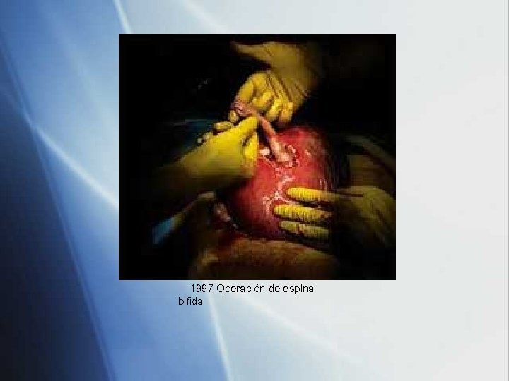 1997 Operación de espina bifida 