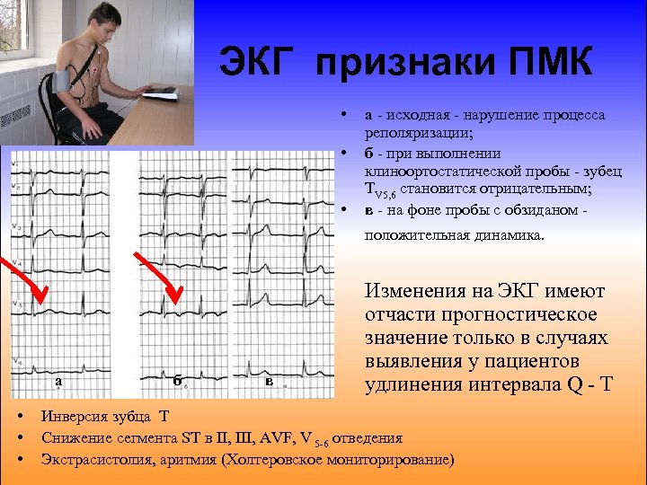 Экг при пролапсе митрального клапана фото