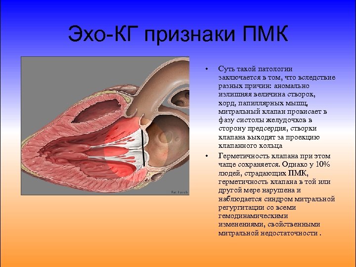 Пролапс митрального клапана презентация