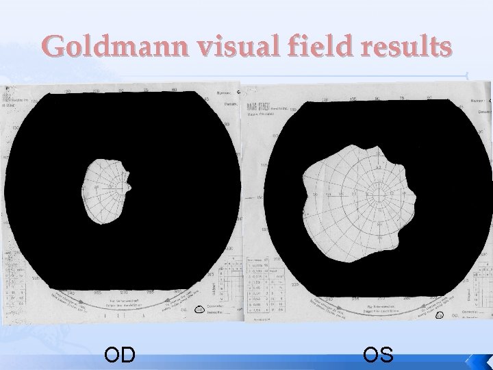 Goldmann visual field results OD OS 