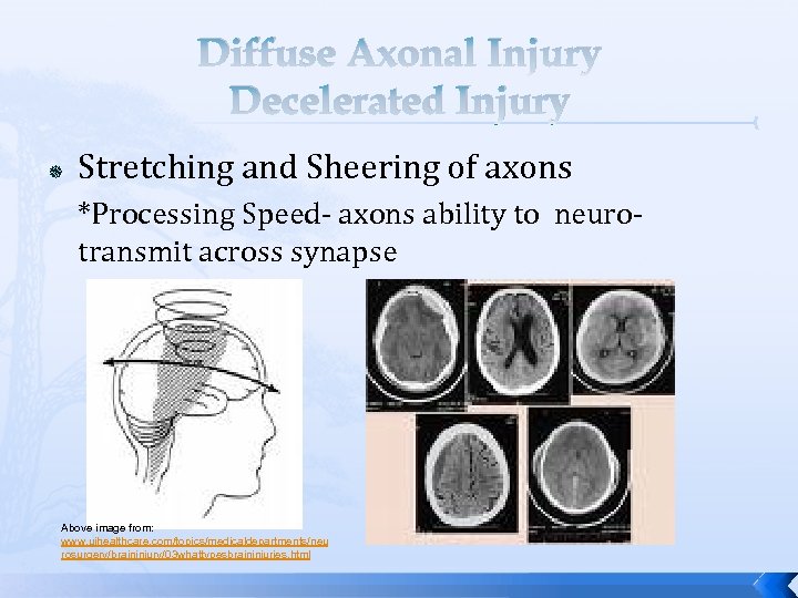 Diffuse Axonal Injury Decelerated Injury Stretching and Sheering of axons *Processing Speed- axons ability