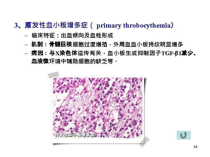 3、原发性血小板增多症（ primary throbocythemia） – 临床特征：出血倾向及血栓形成 – 机制：骨髓巨核细胞过度增殖，外周血血小板持续明显增多 – 病因：与X染色体遗传有关，血小板生成抑制因子TGF- 1减少、 血液微环境中辅助细胞的缺乏等。 34 