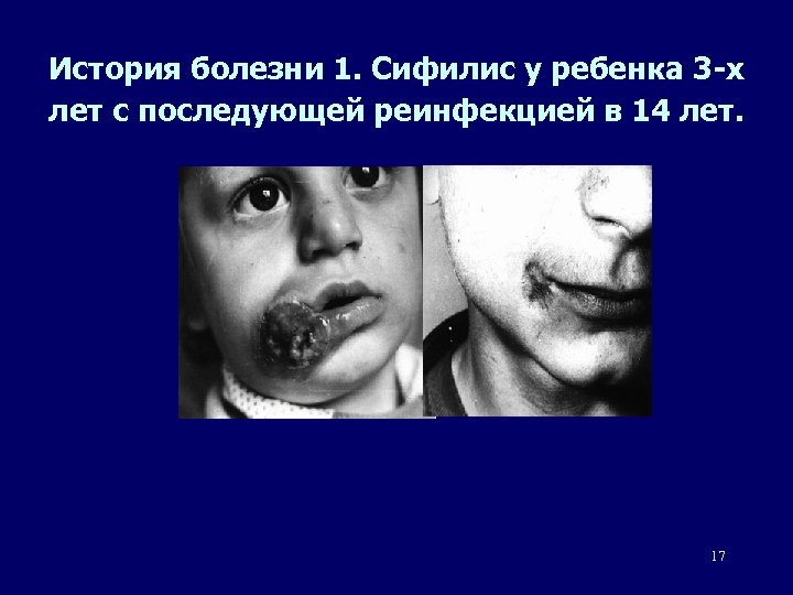 История болезни 1. Сифилис у ребенка 3 -х лет с последующей реинфекцией в 14