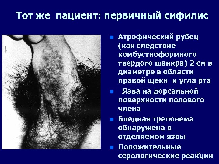 Тот же пациент: первичный сифилис n n Атрофический рубец (как следствие комбустиоформного твердого шанкра)