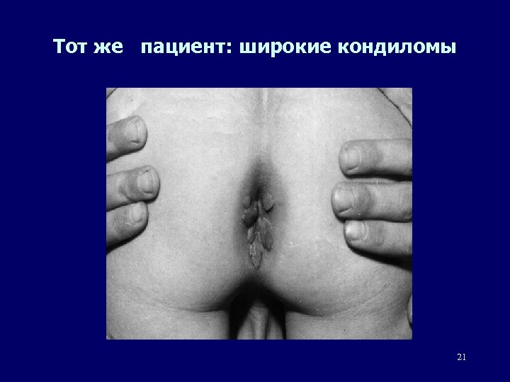Тот же пациент: широкие кондиломы 21 
