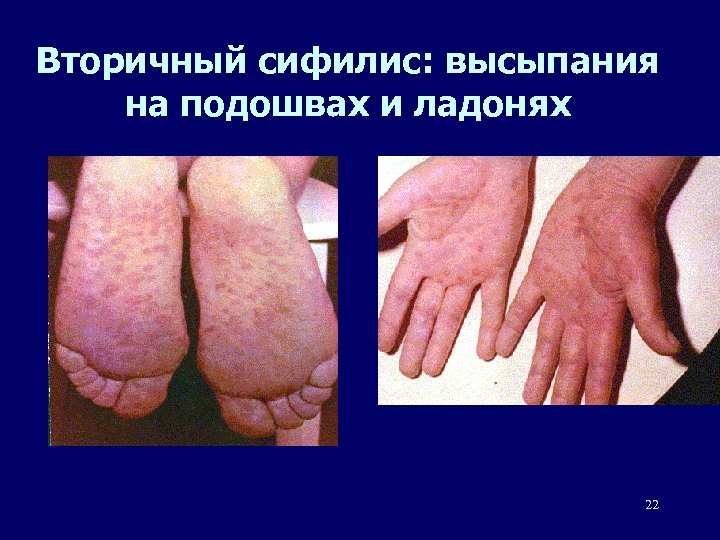 Вторичный сифилис: высыпания на подошвах и ладонях 22 