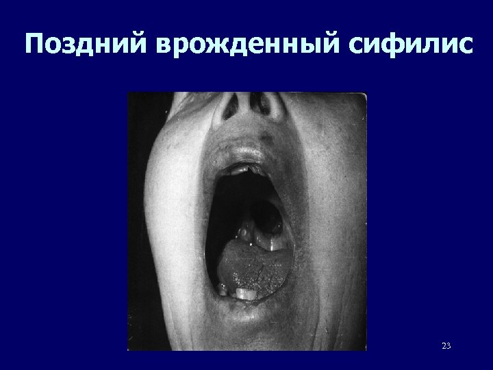 Поздний врожденный сифилис 23 