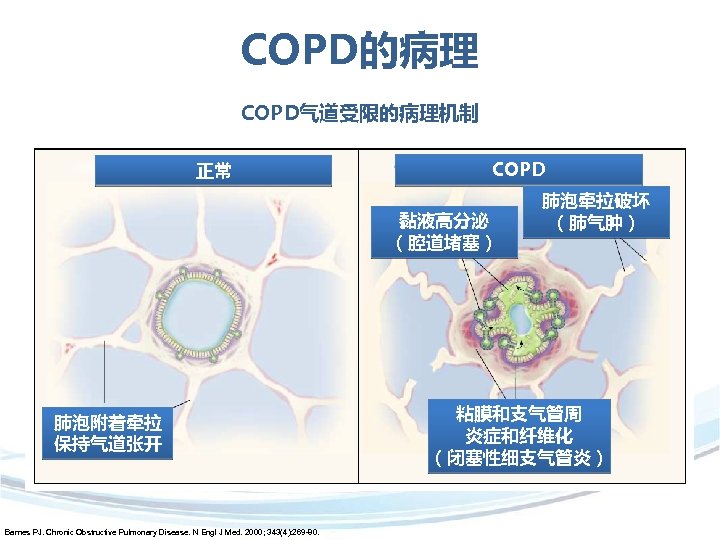 COPD的病理 COPD气道受限的病理机制 正常 COPD 黏液高分泌 （腔道堵塞） 肺泡附着牵拉 保持气道张开 Barnes PJ. Chronic Obstructive Pulmonary Disease.