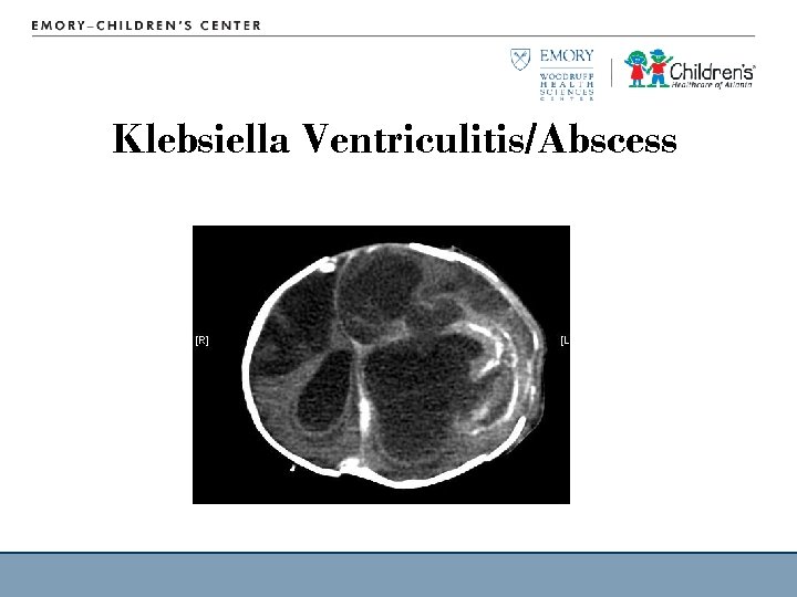 Klebsiella Ventriculitis/Abscess 