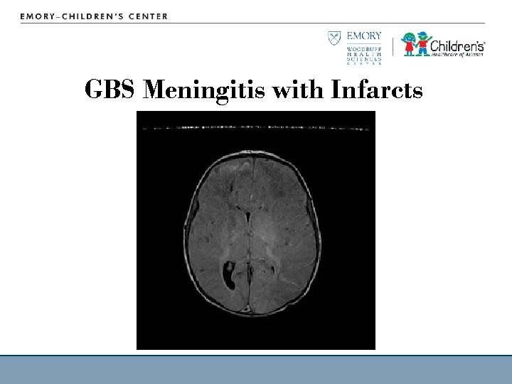 GBS Meningitis with Infarcts 