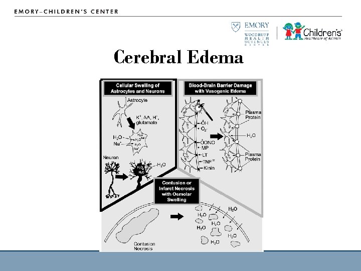 Cerebral Edema 