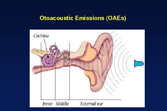 Otoacoustic Emissions (OAEs) 