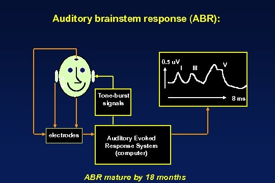 Auditory brainstem response (ABR): 0. 5 u. V I Tone-burst signals electrodes Auditory Evoked