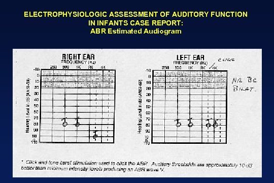 ELECTROPHYSIOLOGIC ASSESSMENT OF AUDITORY FUNCTION IN INFANTS CASE REPORT: ABR Estimated Audiogram 