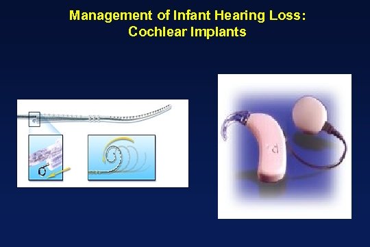 Management of Infant Hearing Loss: Cochlear Implants 