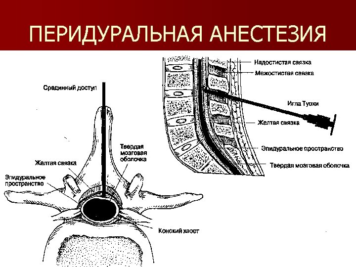 ПЕРИДУРАЛЬНАЯ АНЕСТЕЗИЯ 