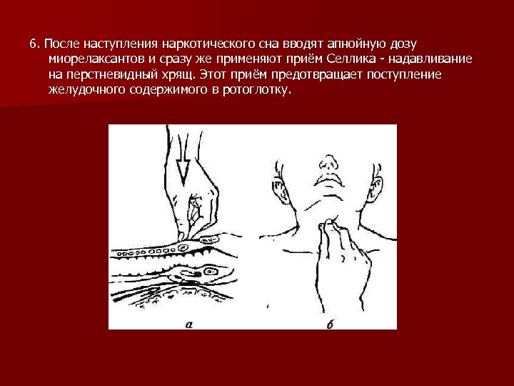 6. После наступления наркотического сна вводят апнойную дозу миорелаксантов и сразу же применяют приём