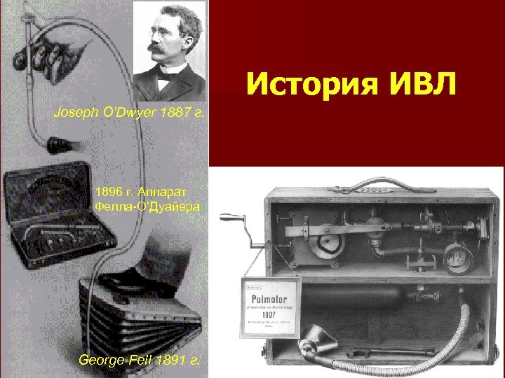История ИВЛ Joseph O'Dwyer 1887 г. 1896 г. Аппарат Фелла-О’Дуайера George Fell 1891 г.