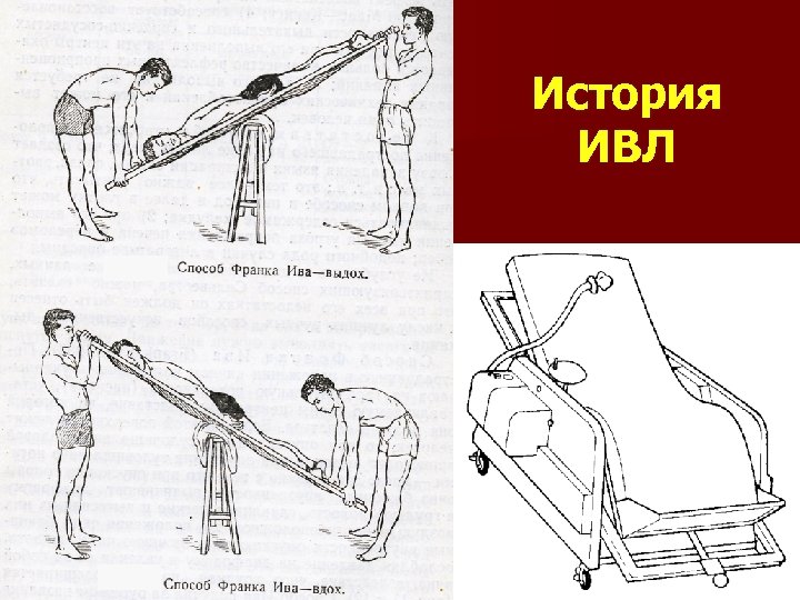 История ИВЛ 