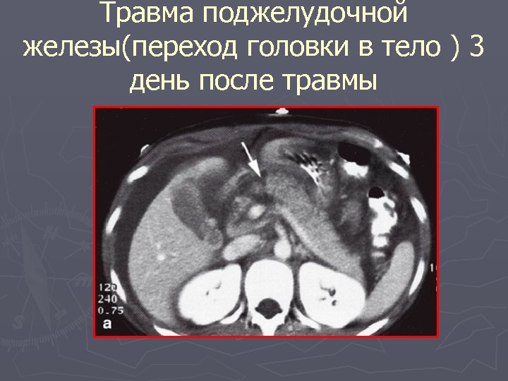 Травма поджелудочной железы(переход головки в тело ) 3 день после травмы 