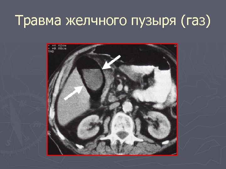 Травма желчного пузыря (газ) 