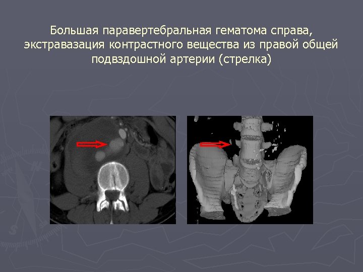 Большая паравертебральная гематома справа, экстравазация контрастного вещества из правой общей подвздошной артерии (стрелка) 