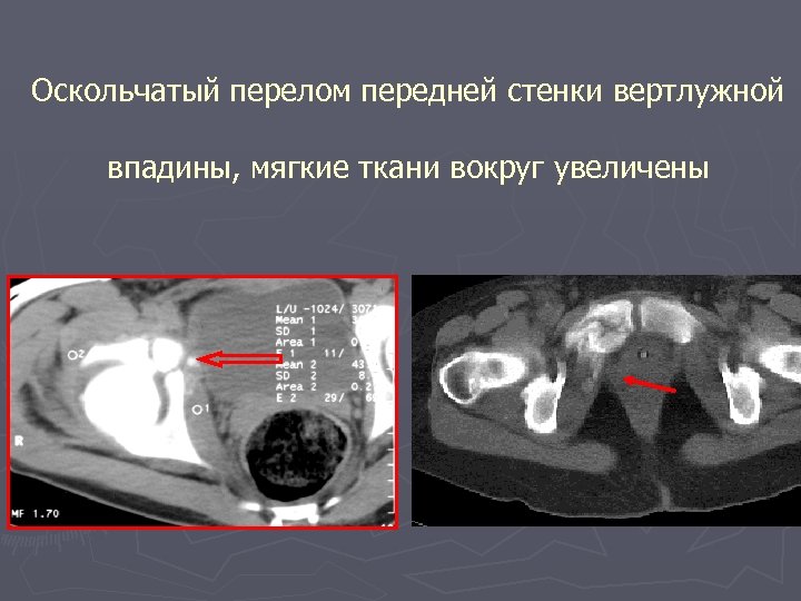 Оскольчатый перелом передней стенки вертлужной впадины, мягкие ткани вокруг увеличены 