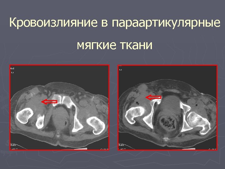 Кровоизлияние в параартикулярные мягкие ткани 