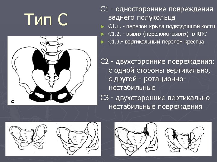 Тип С С 1 - односторонние повреждения заднего полукольца С 1. 1. - перелом