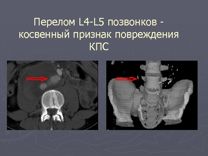 Перелом L 4 -L 5 позвонков косвенный признак повреждения КПС 