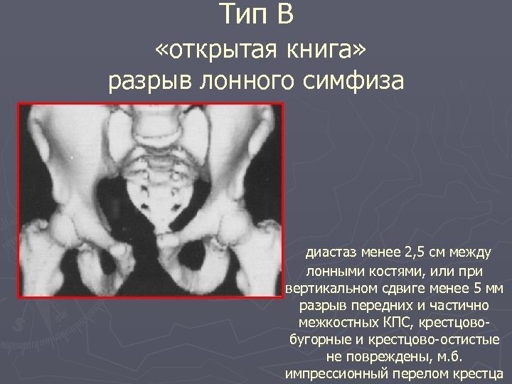 Тип В «открытая книга» разрыв лонного симфиза диастаз менее 2, 5 см между лонными