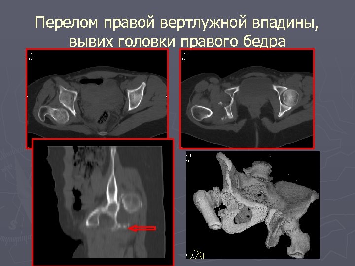 Перелом правой вертлужной впадины, вывих головки правого бедра 