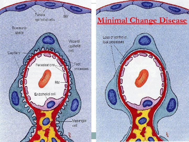 Minimal Change Disease 