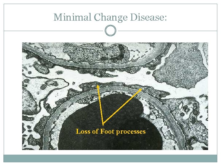 Minimal Change Disease: Loss of Foot processes 