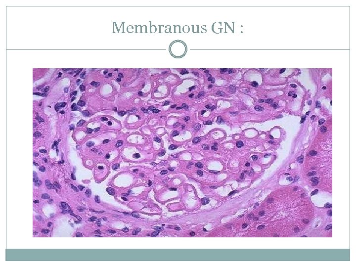 Membranous GN : 