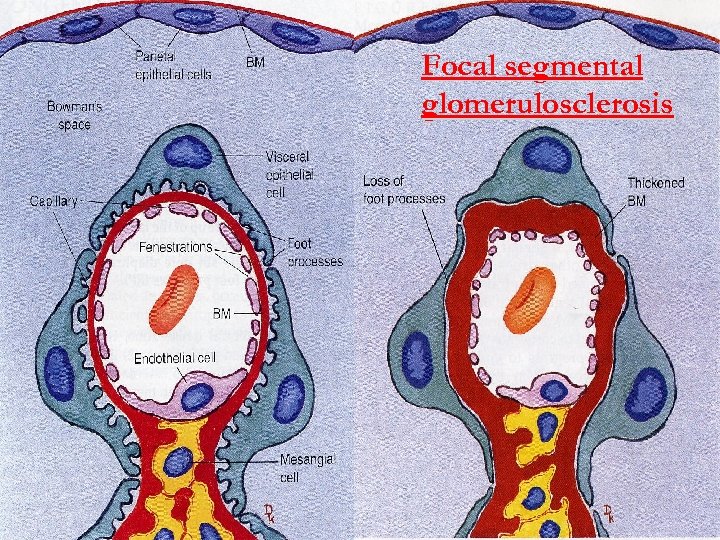 Focal segmental glomerulosclerosis 