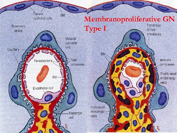 Membranoproliferative GN Type I 