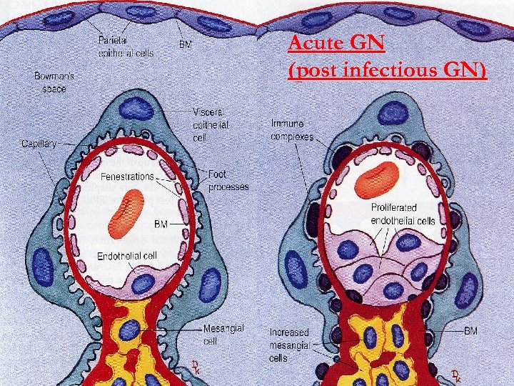 Acute GN (post infectious GN) 